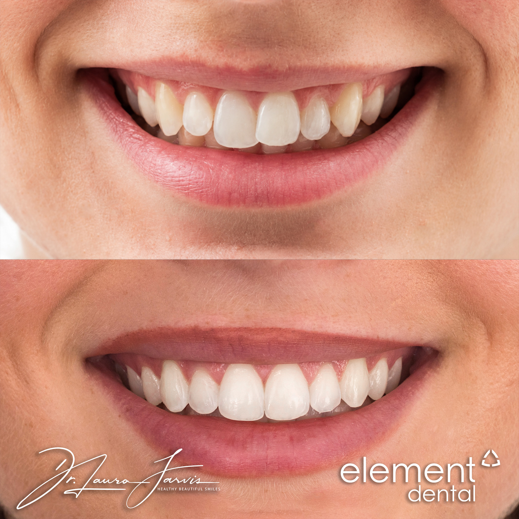Clear aligners — Patient 001