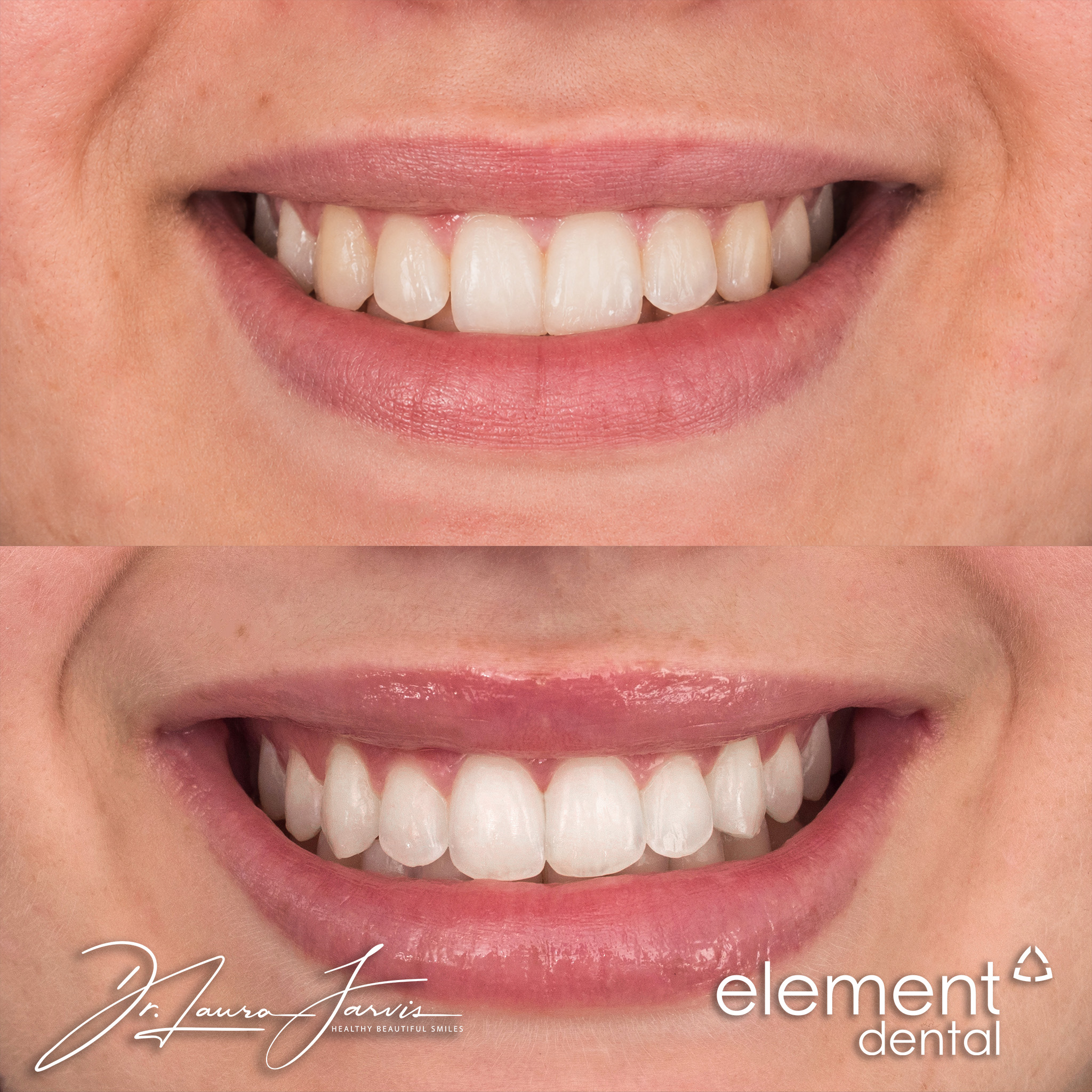 Clear aligners — Patient 002