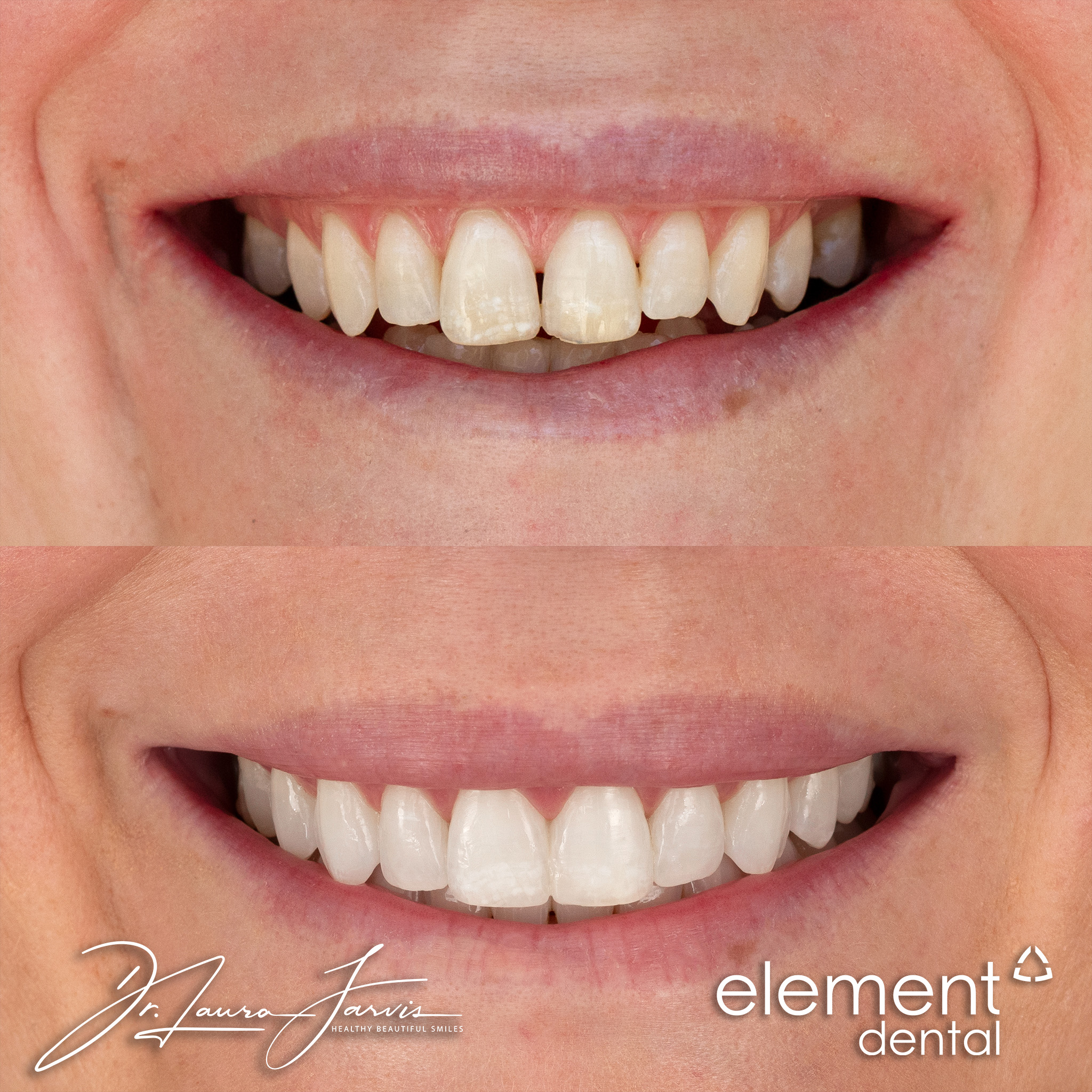 Clear aligners — Patient 004