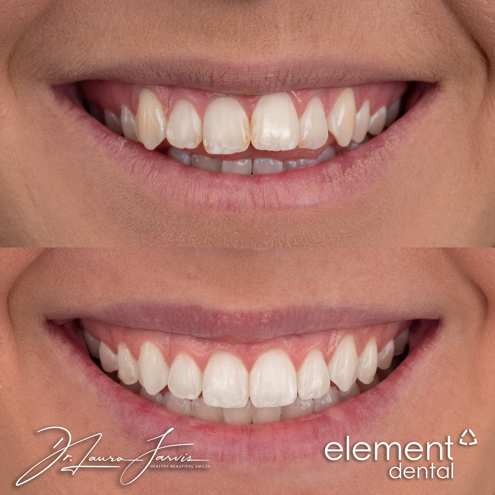Clear aligners — Patient 005