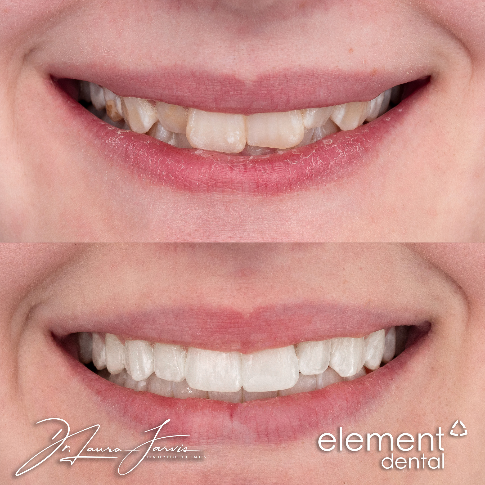 Clear aligners — Patient 006