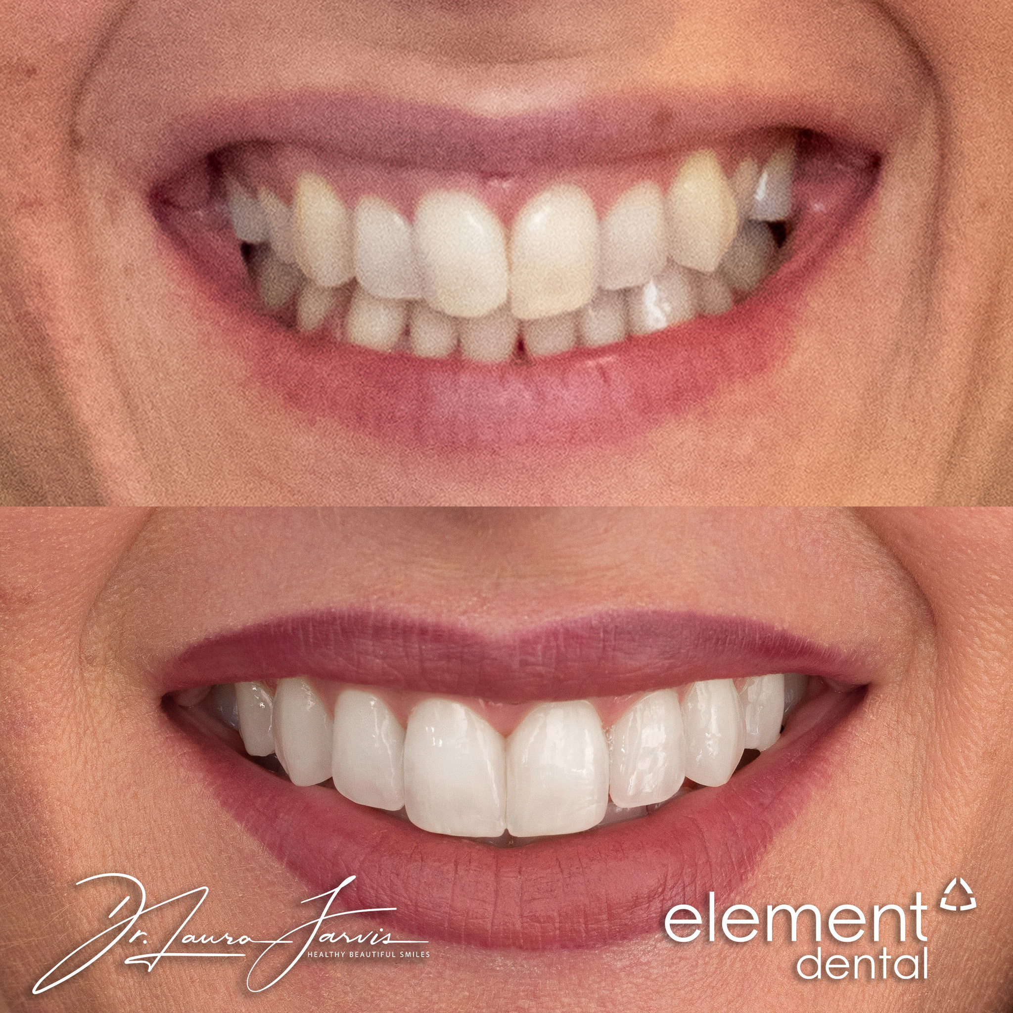 Clear aligners — Patient 007