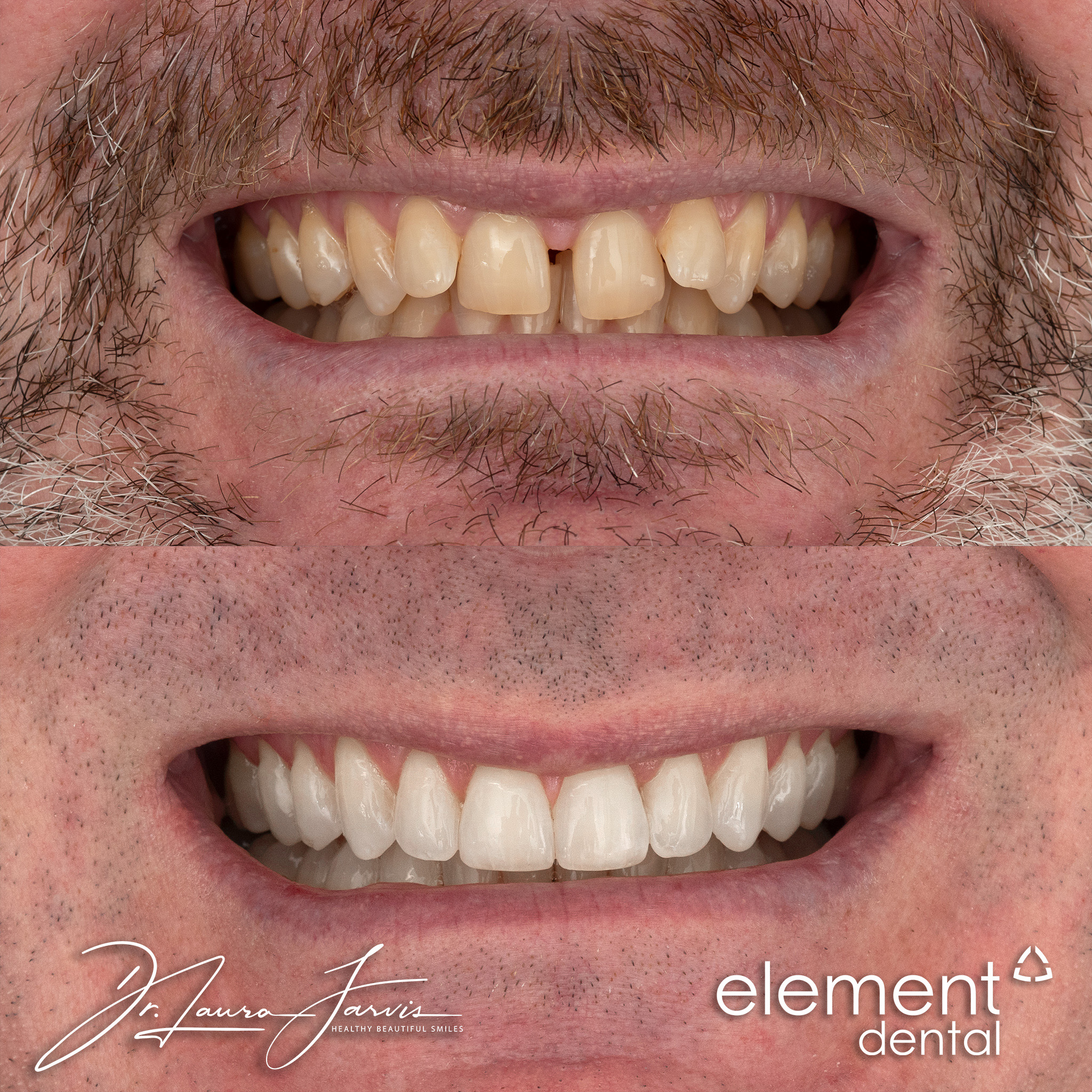 Clear aligners — Patient 008