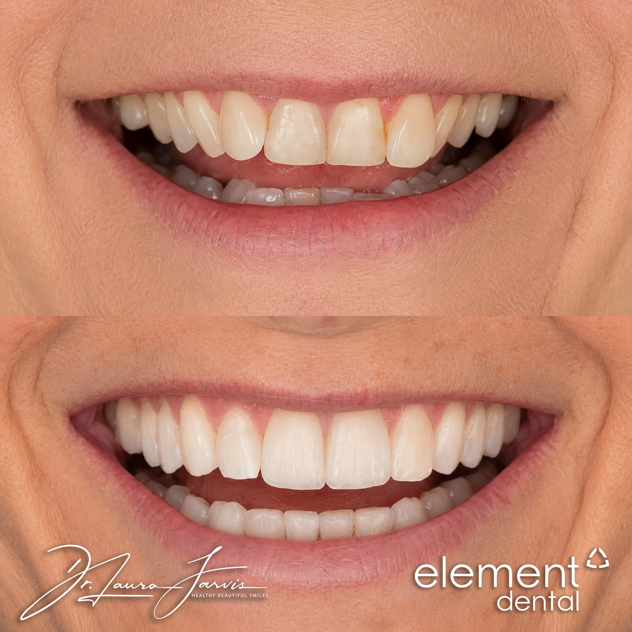 Clear aligners — Patient 009