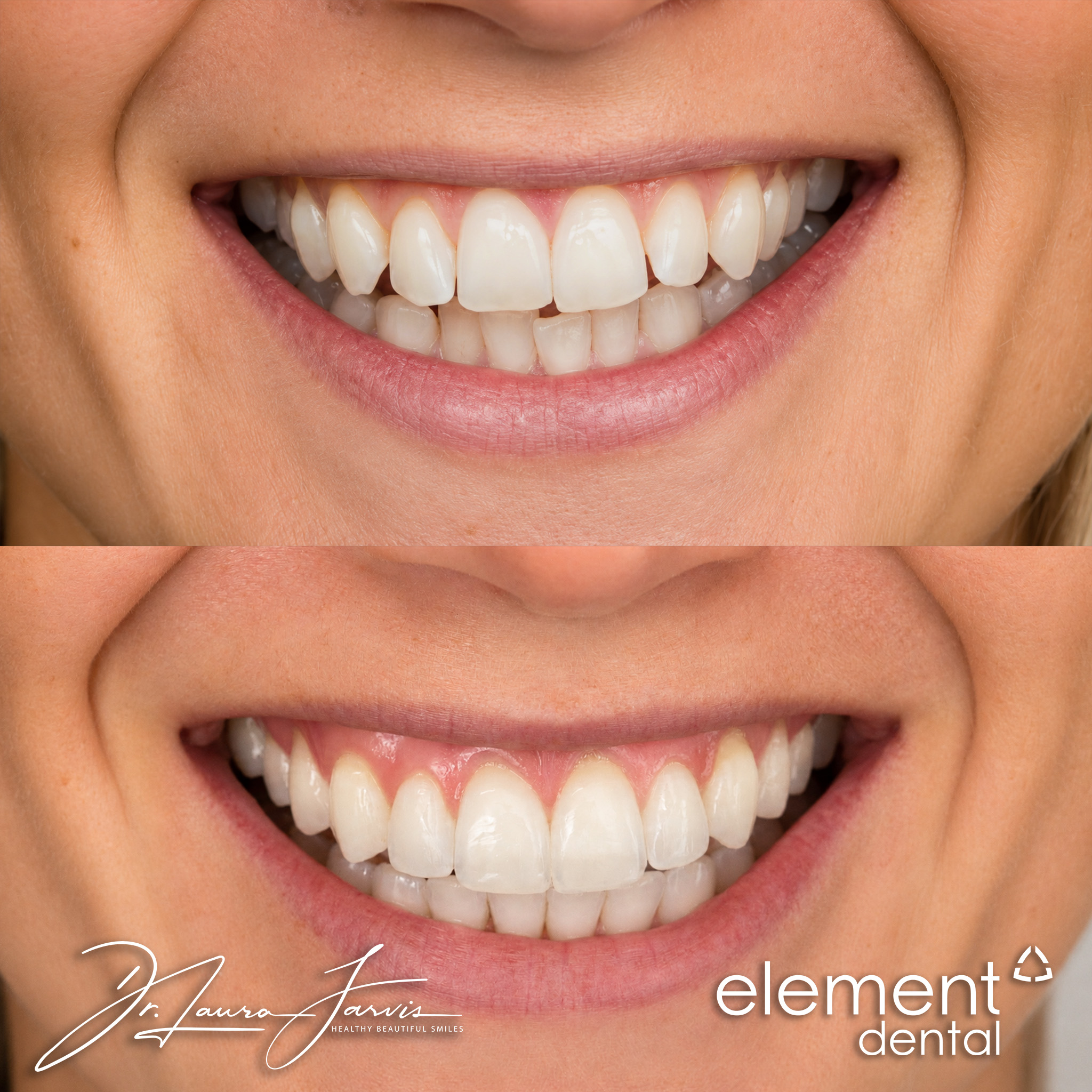 Clear aligners — Patient 010
