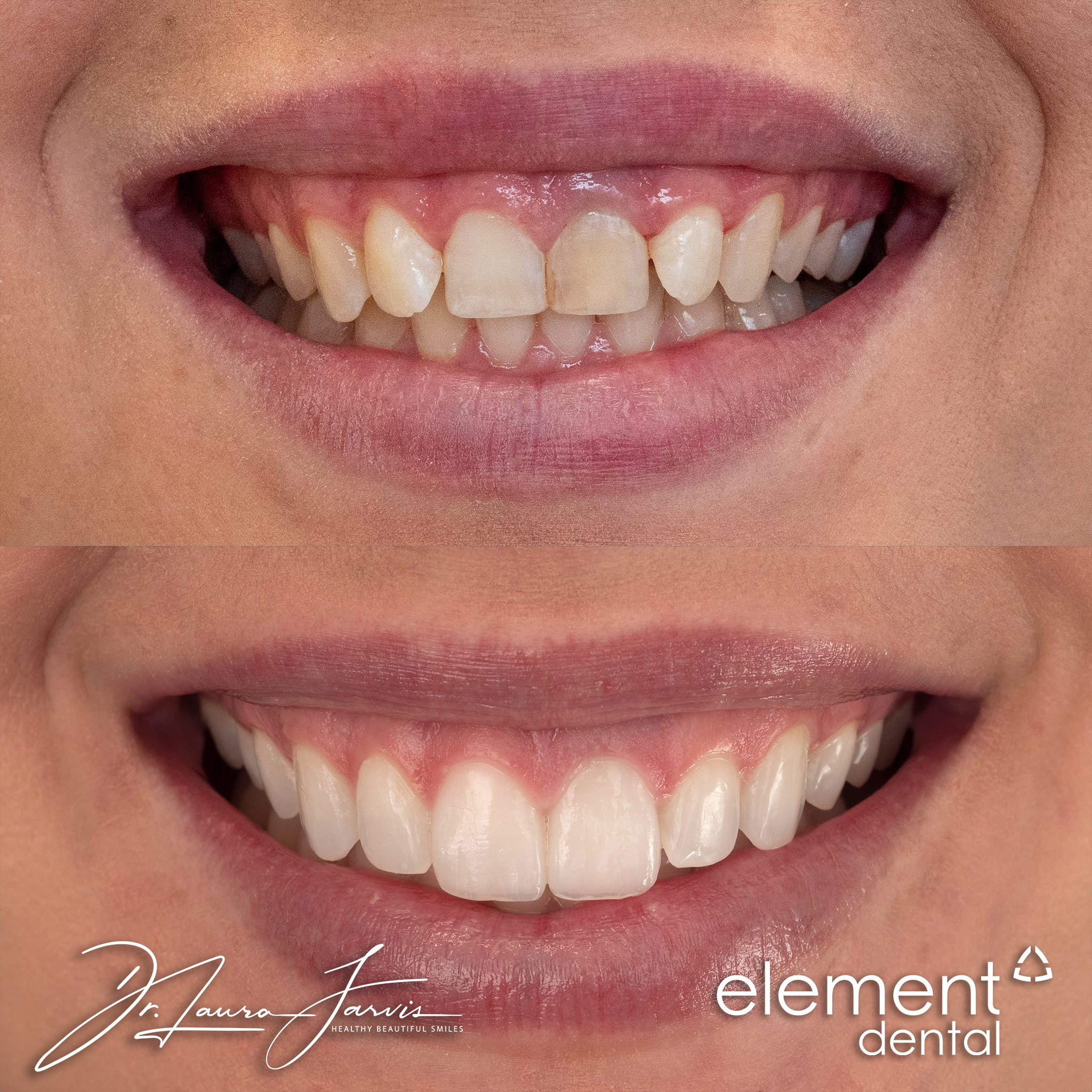Clear aligners — Patient 011