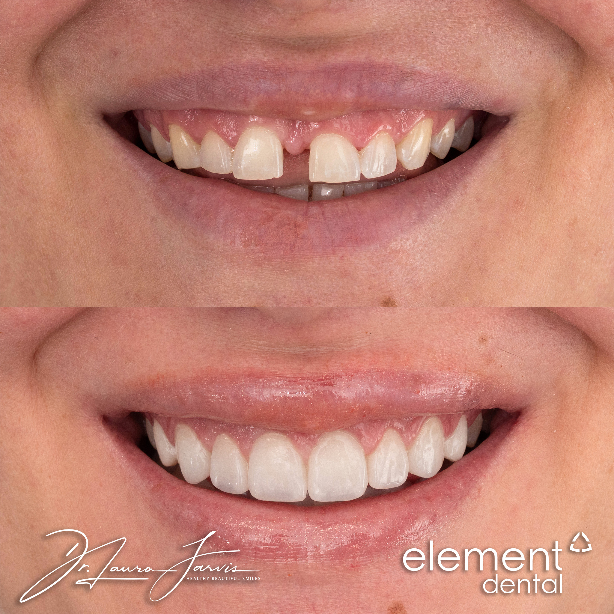 Clear aligners — Patient 012