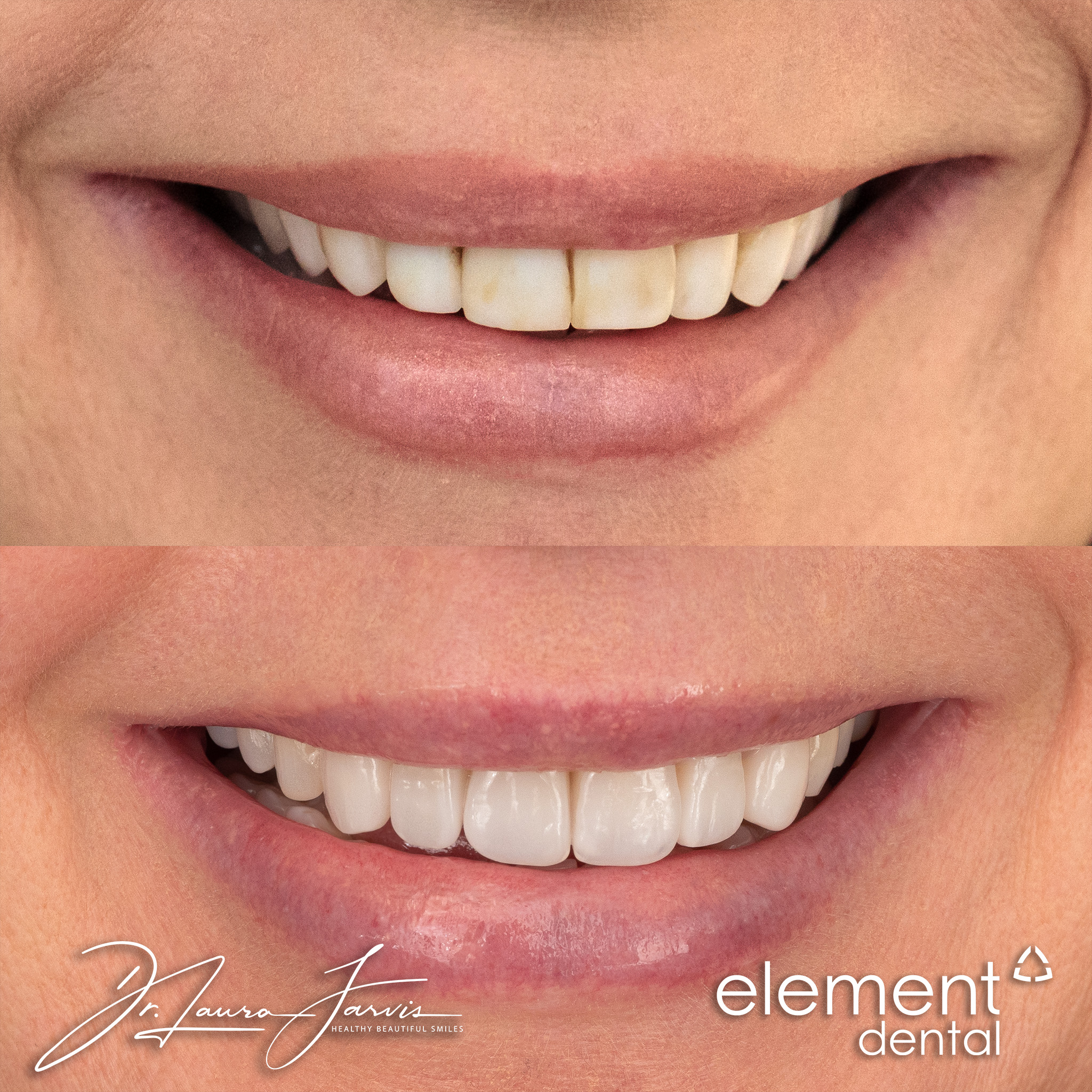 Clear aligners — Patient 016