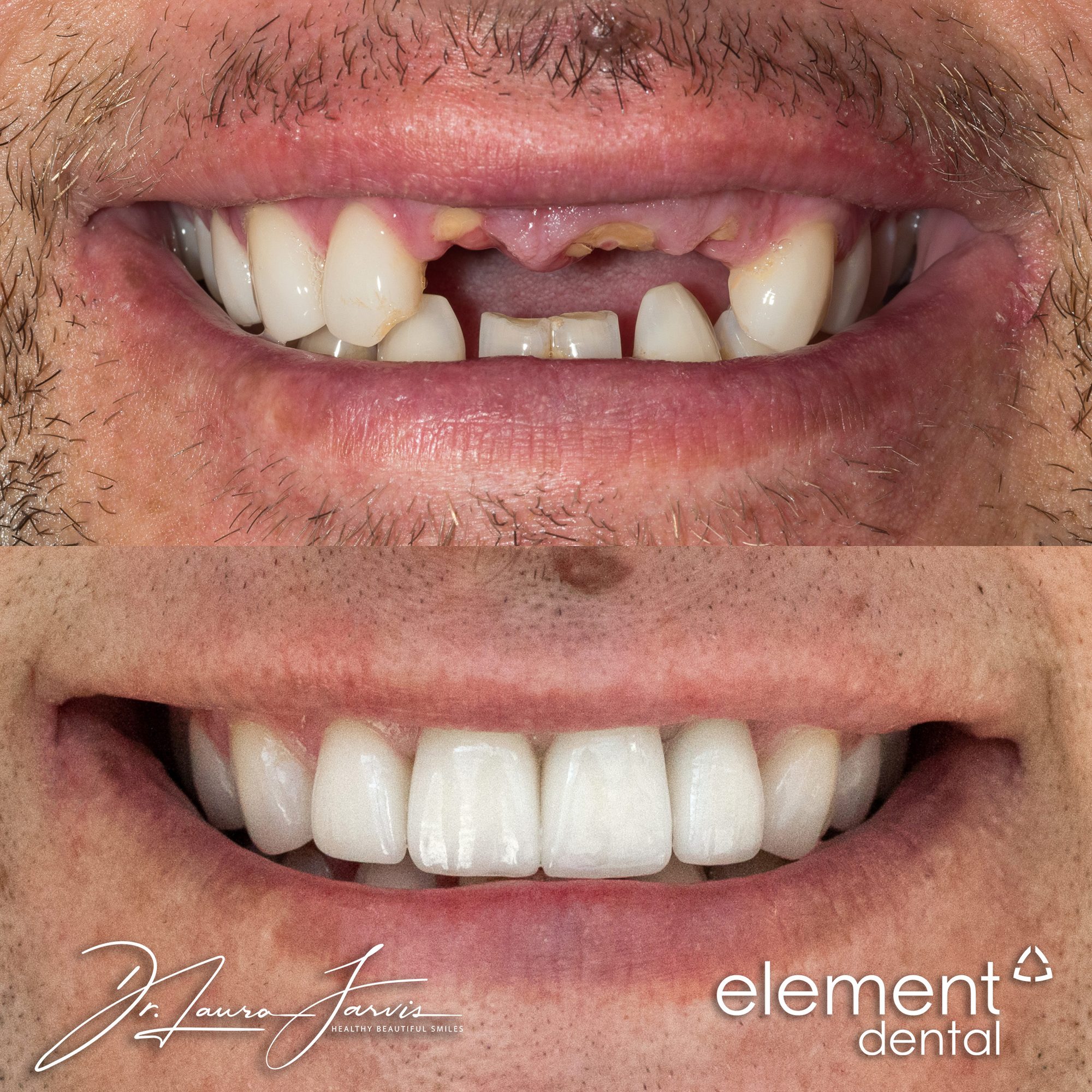 Dental implant — Patient 019