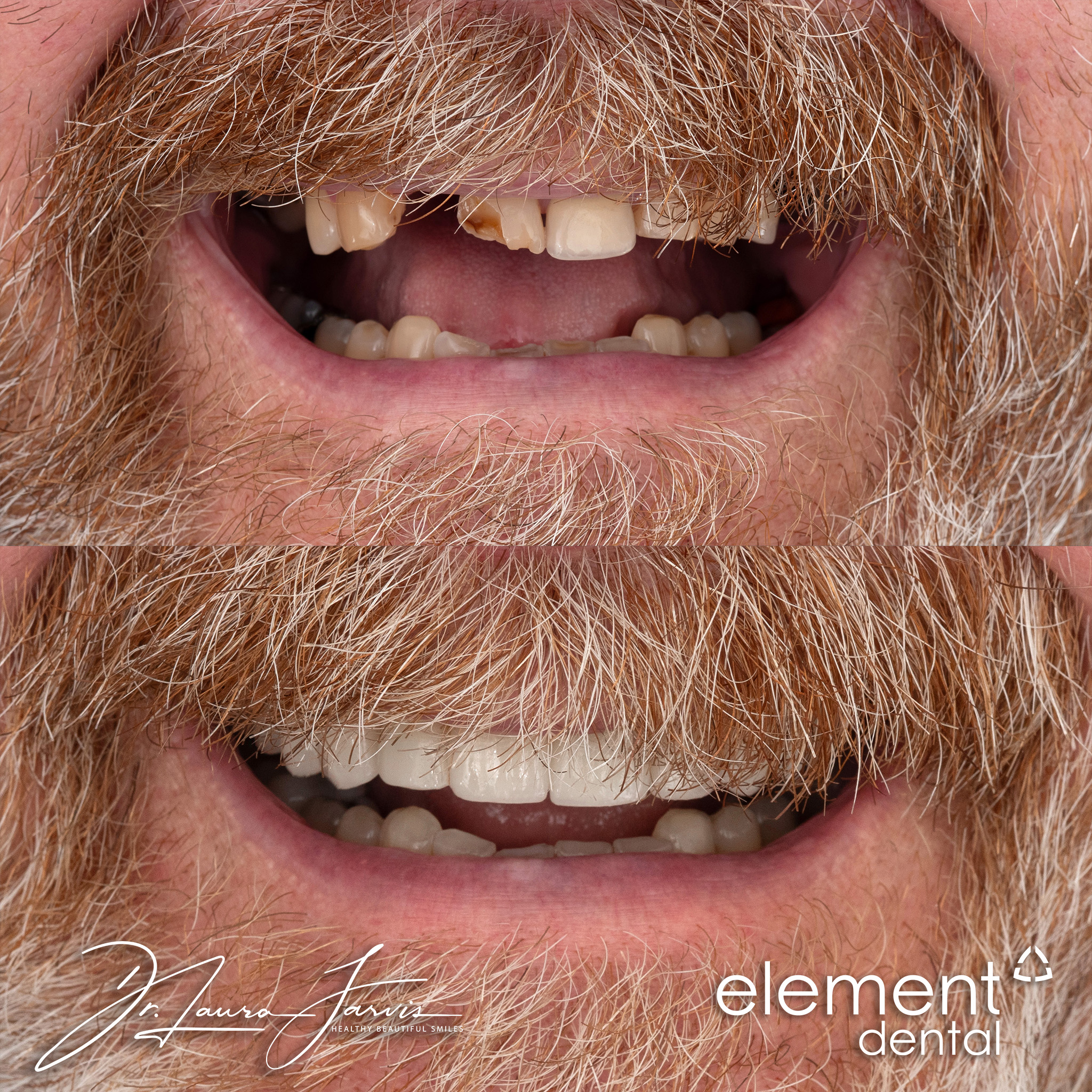 Dental implant — Patient 025
