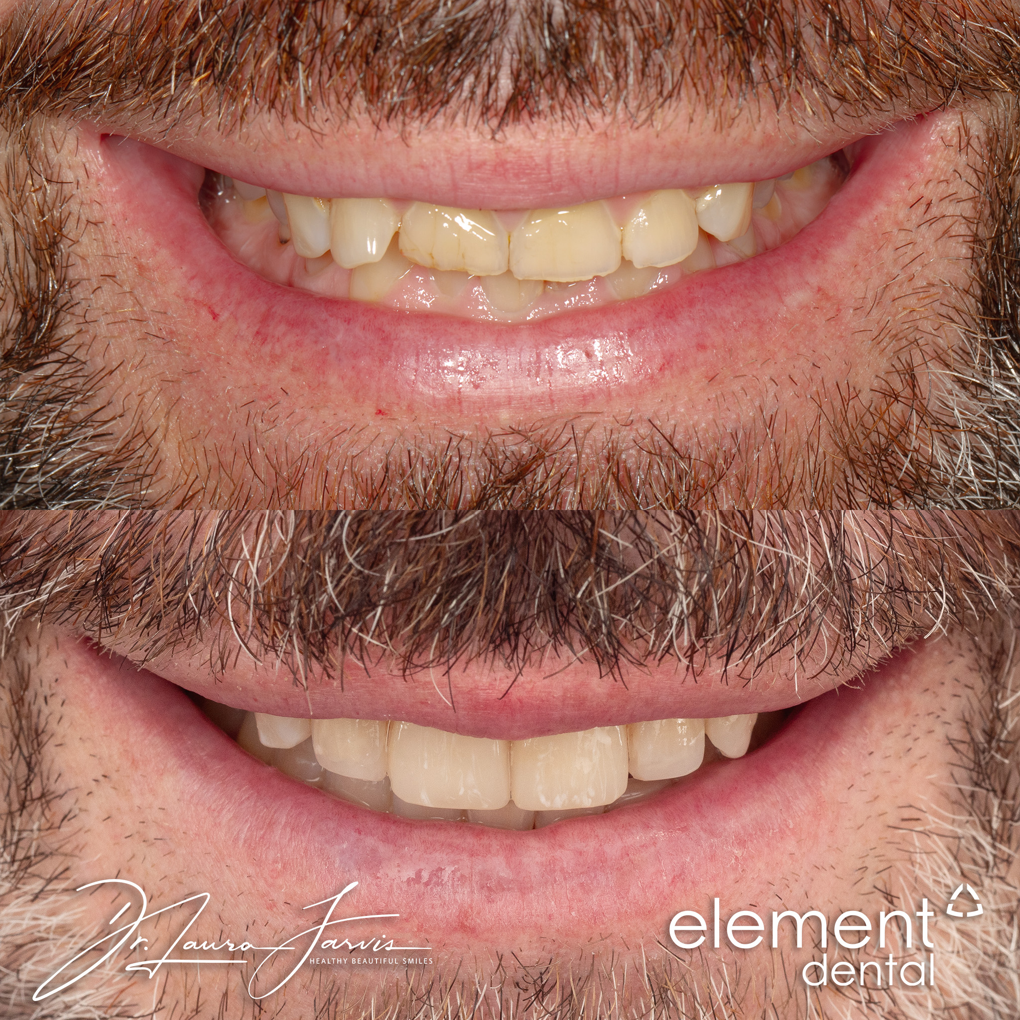 Clear aligners — Patient 027