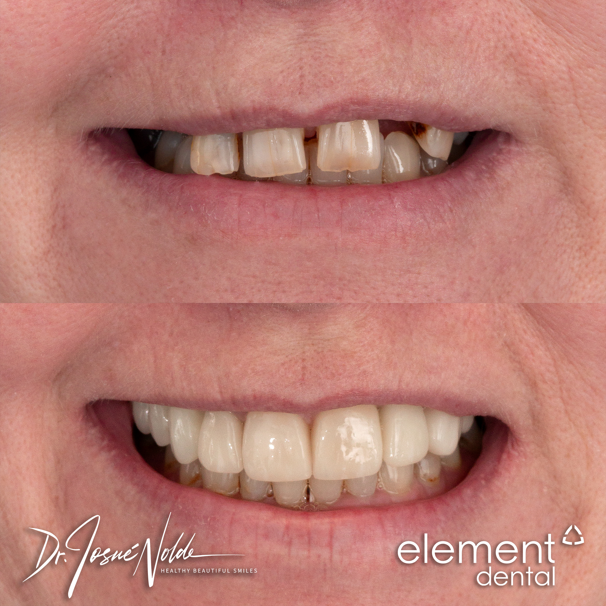 Dental implant — Patient 028