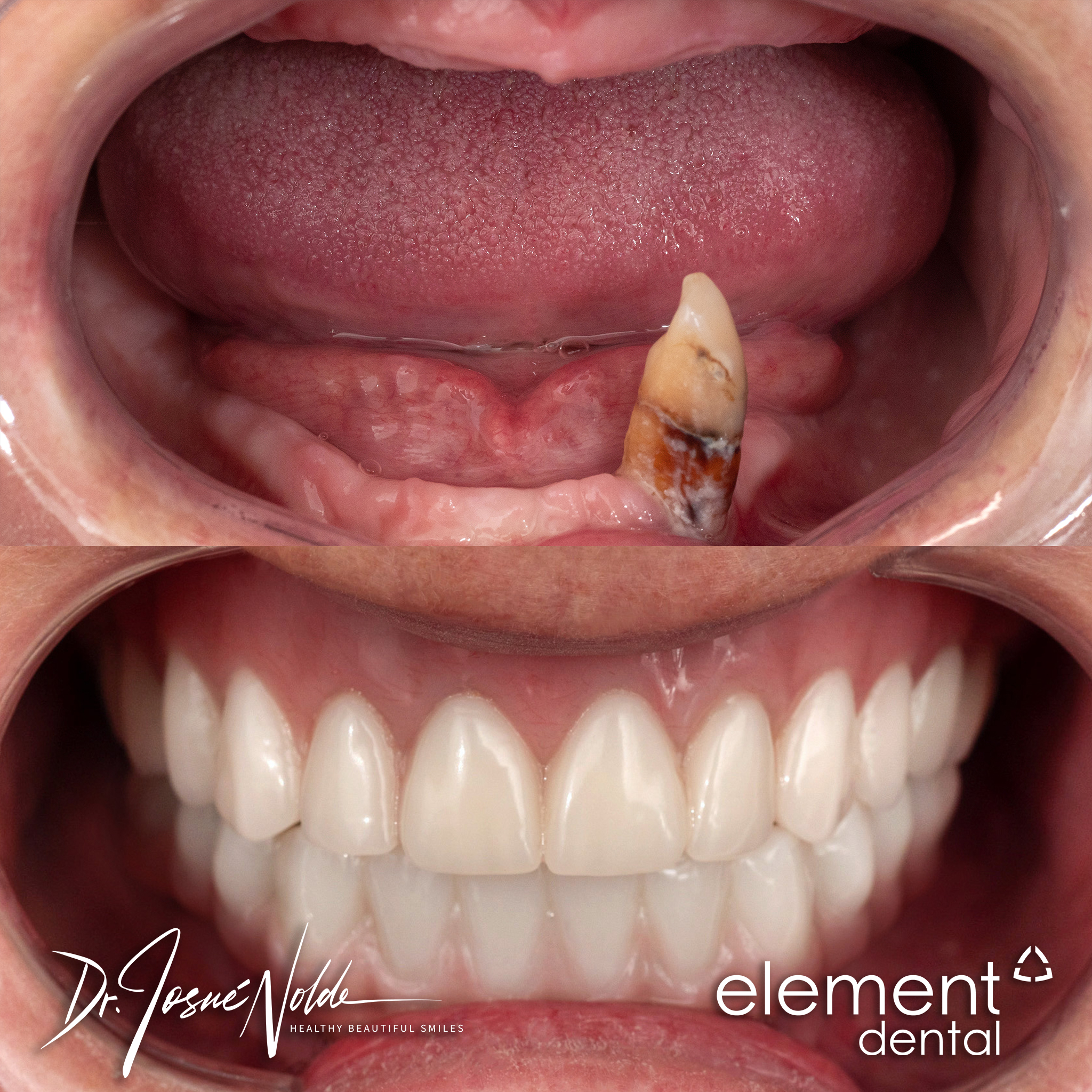 Dental implant — Patient 029