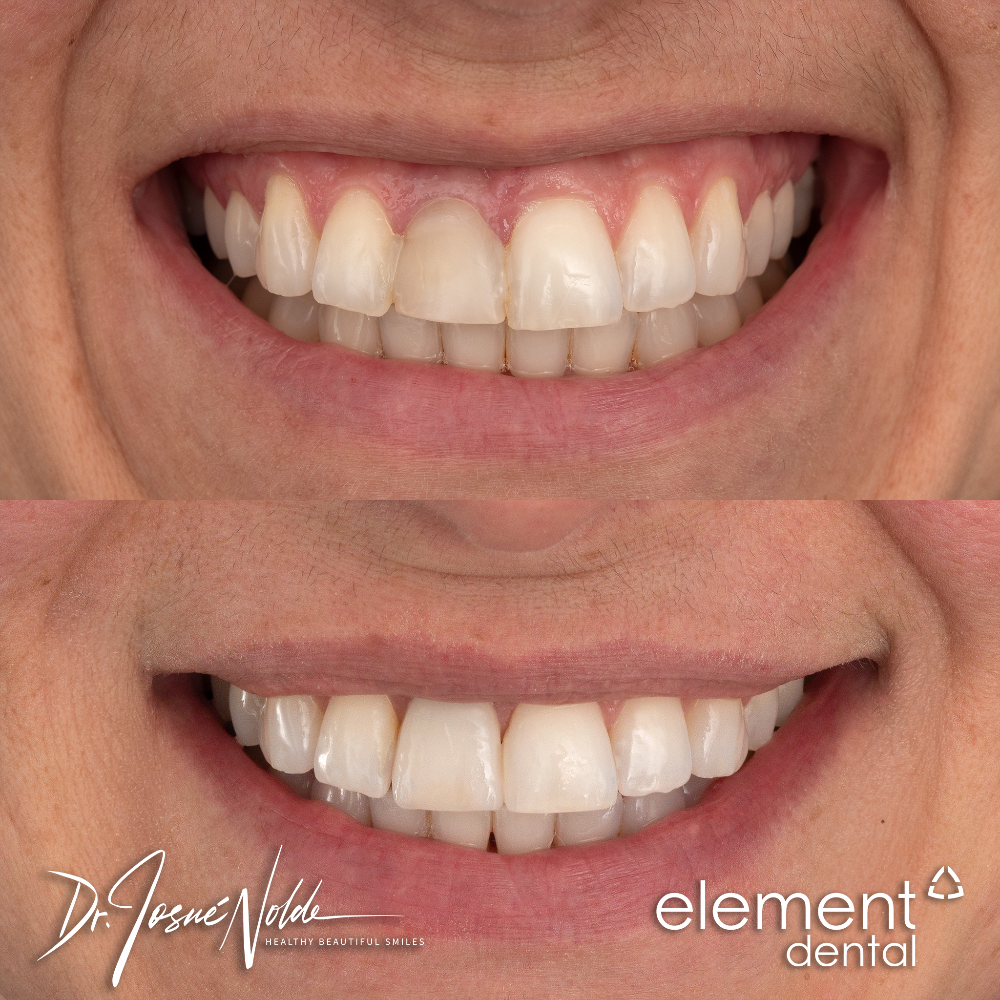 Dental implant — Patient 030