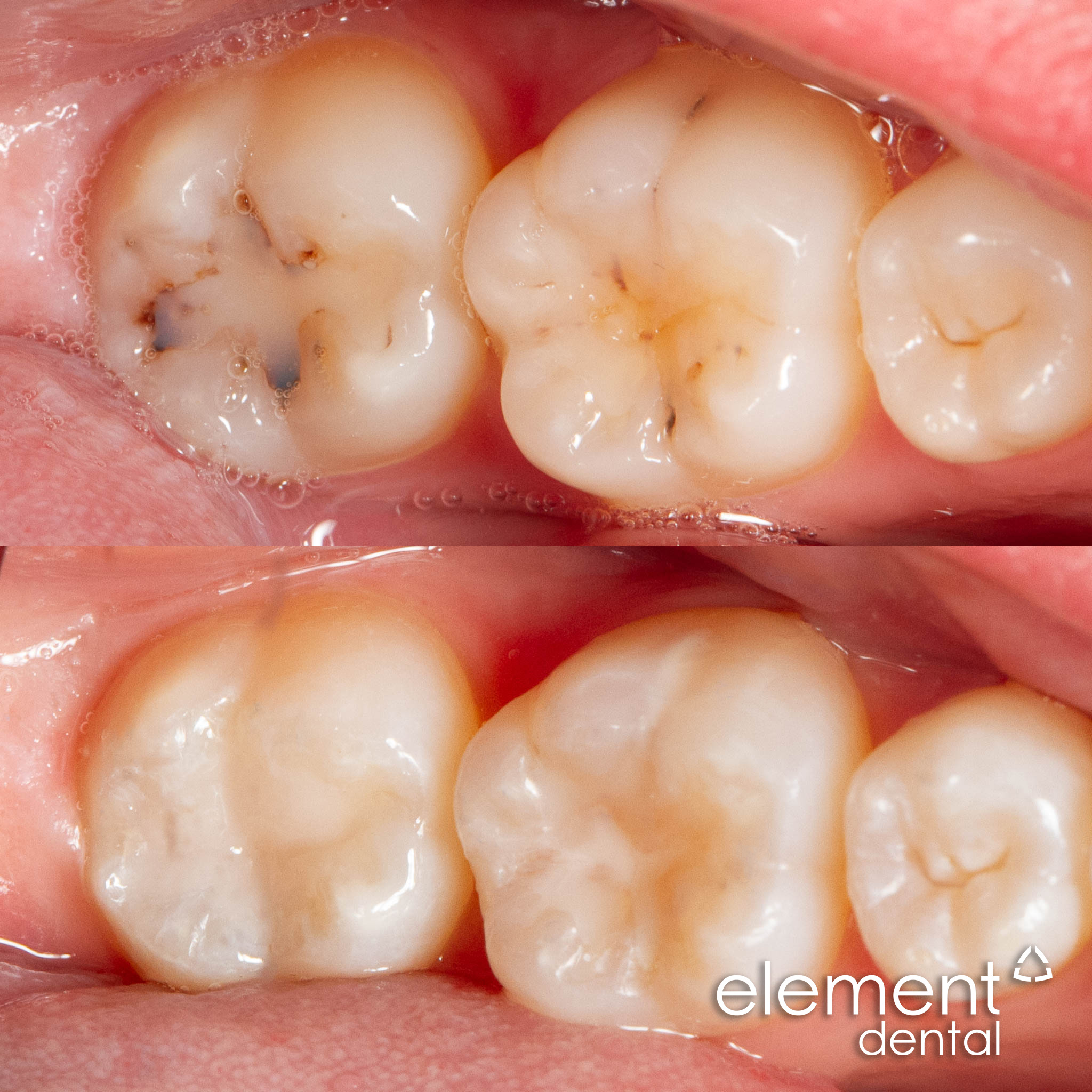 Dental filling result at Element Dental