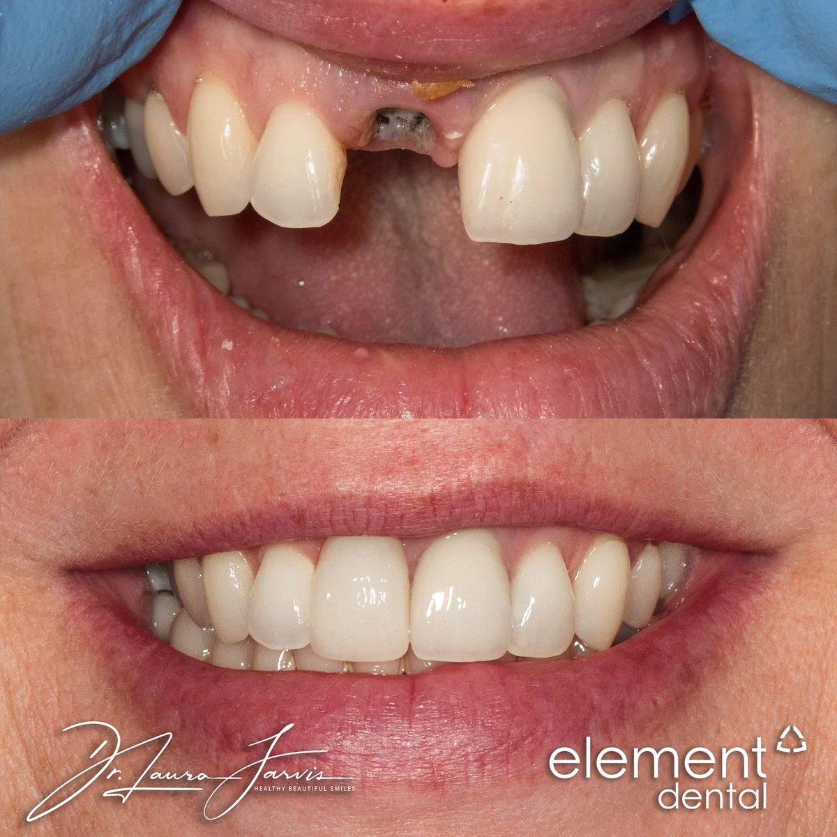 Dental implant — Immediate Implant