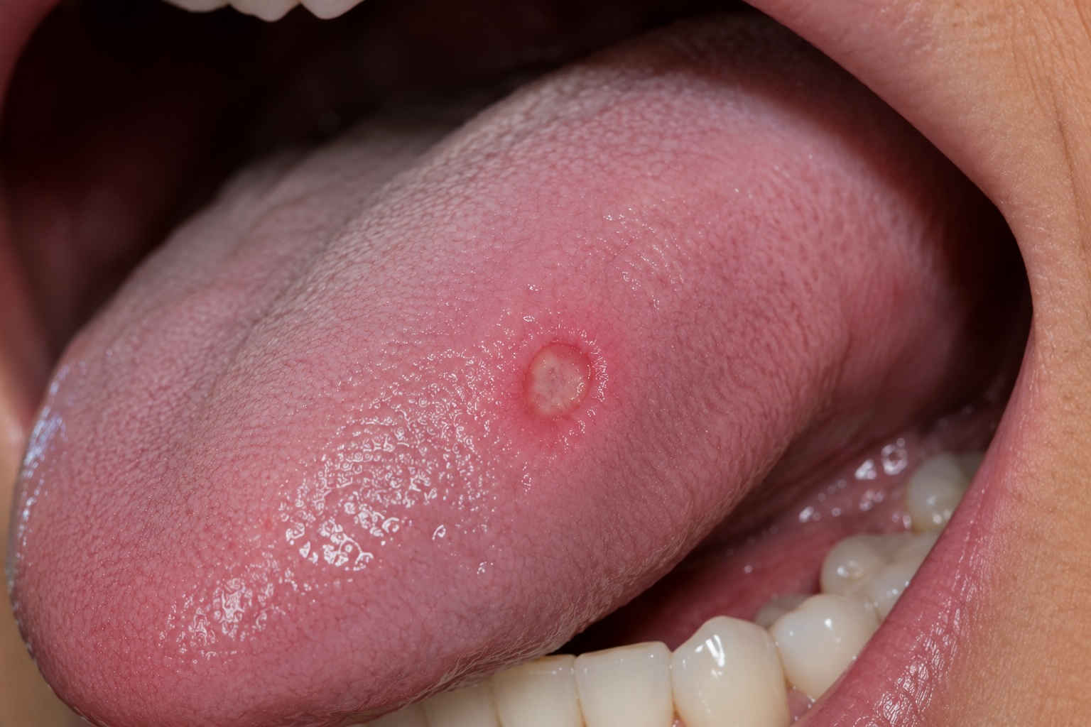 Early squamous cell carcinoma lesion on the lateral tongue or floor of mouth