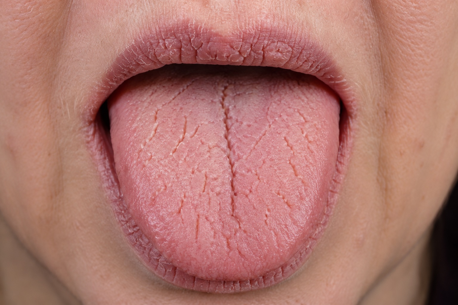 Dry, fissured tongue with reduced salivary flow — Sjögren's syndrome