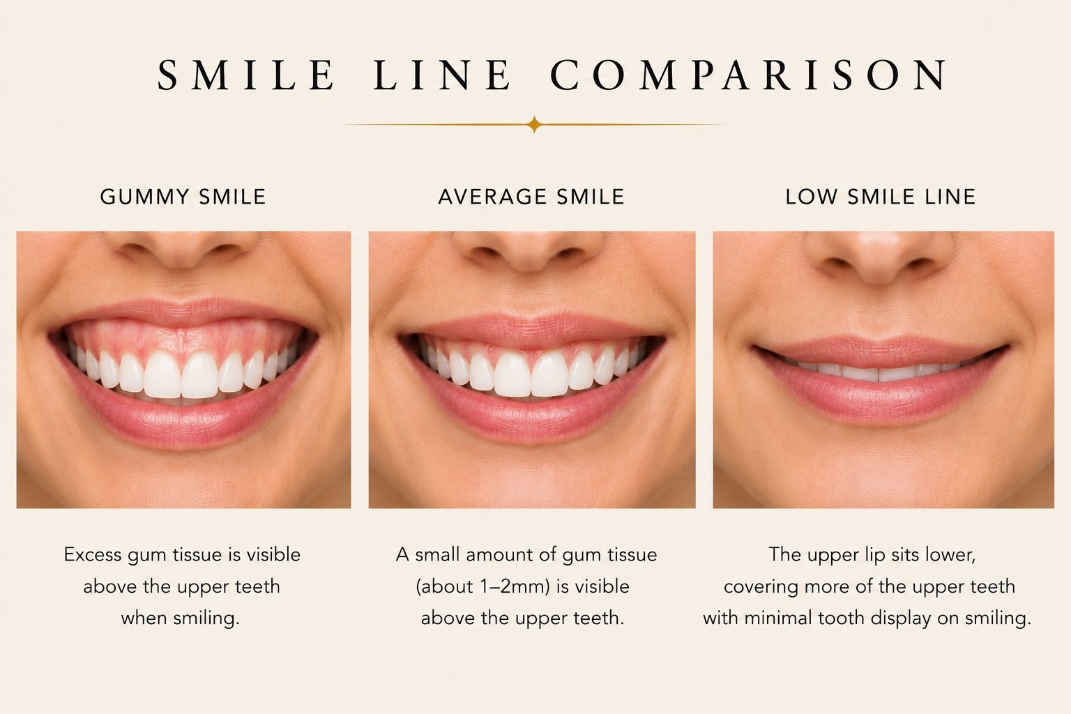 Smile line and gum display — ideal, gummy, and low lip line