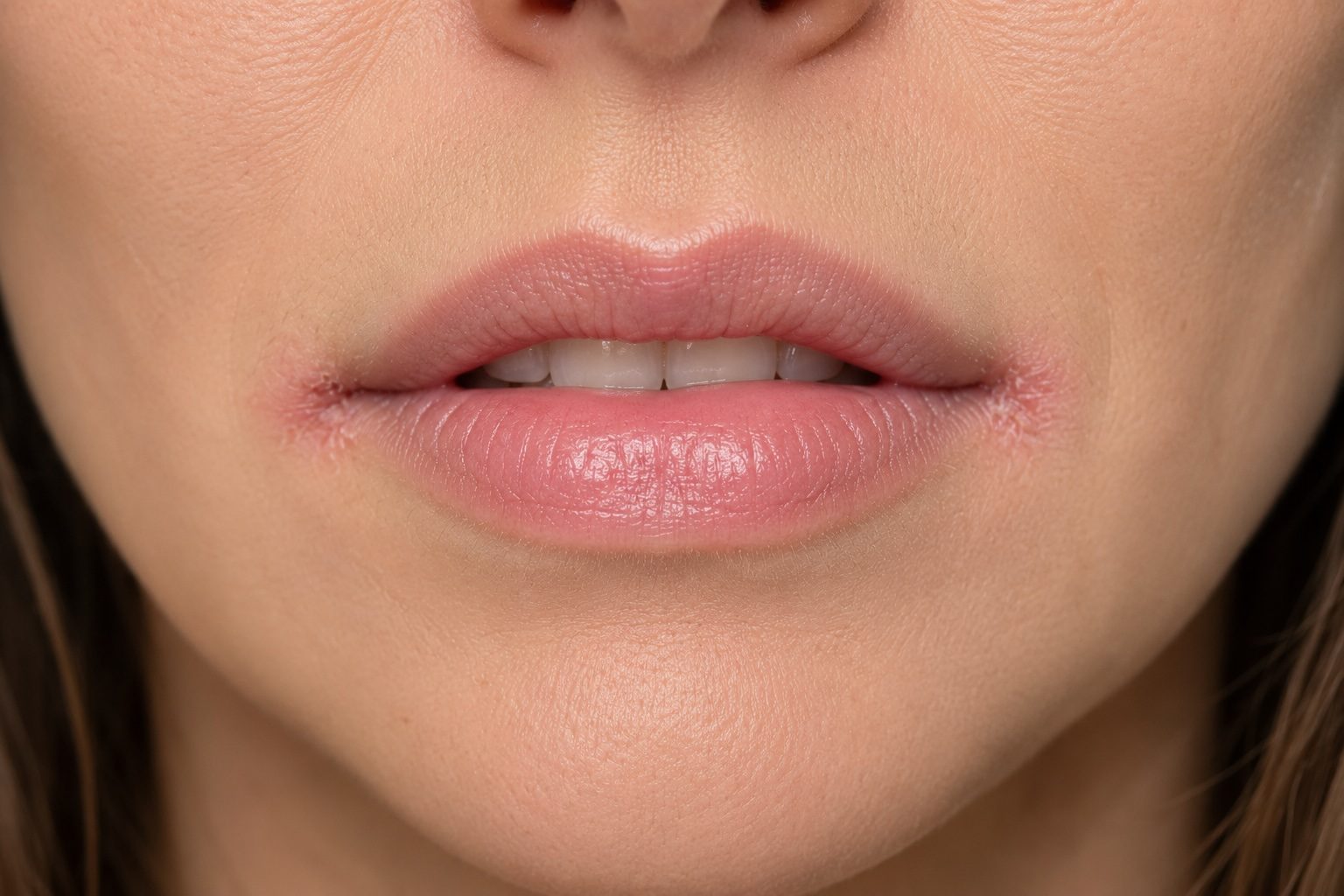 Angular cheilitis — cracking and inflammation at the corners of the mouth