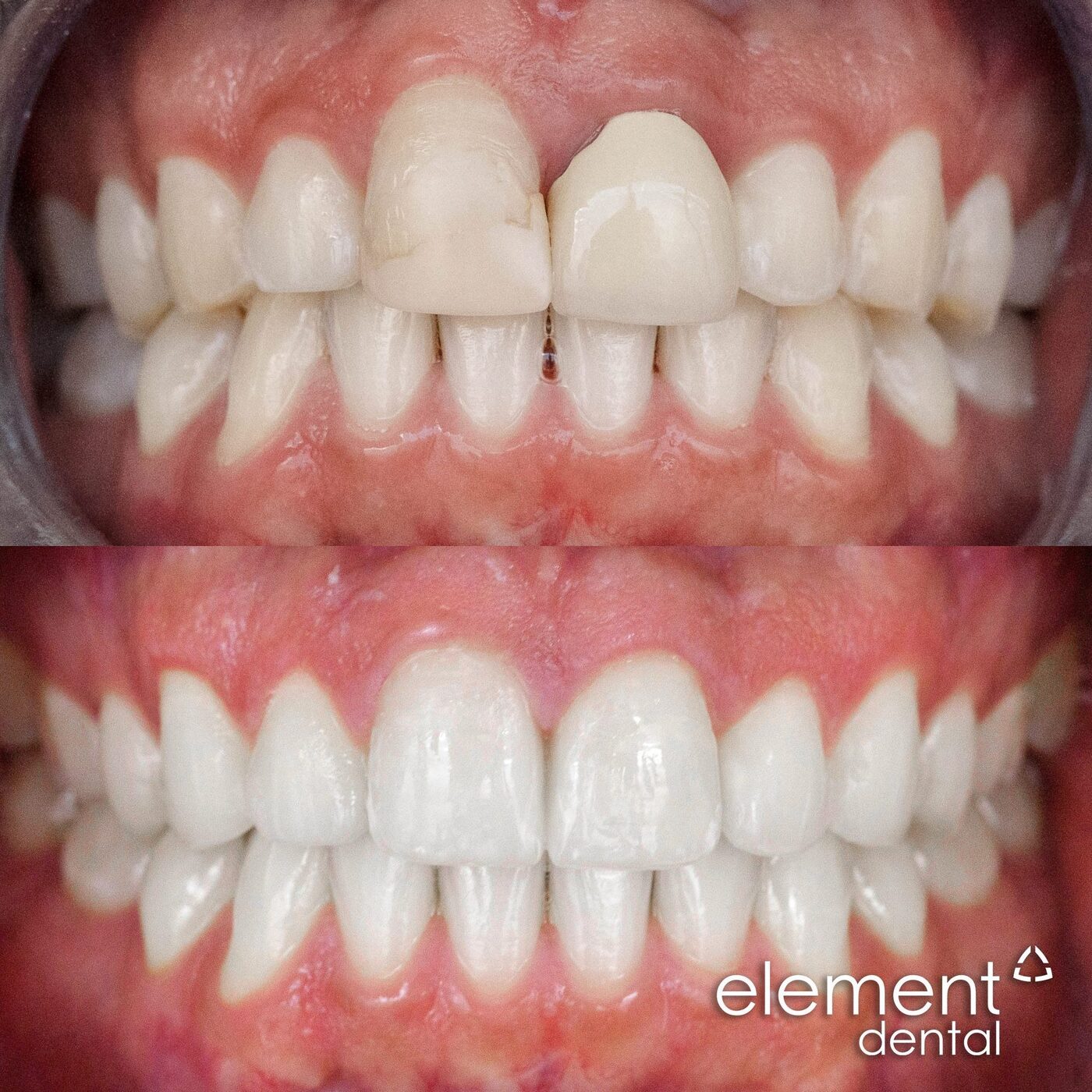 Gum sculpting before and after — Element Dental