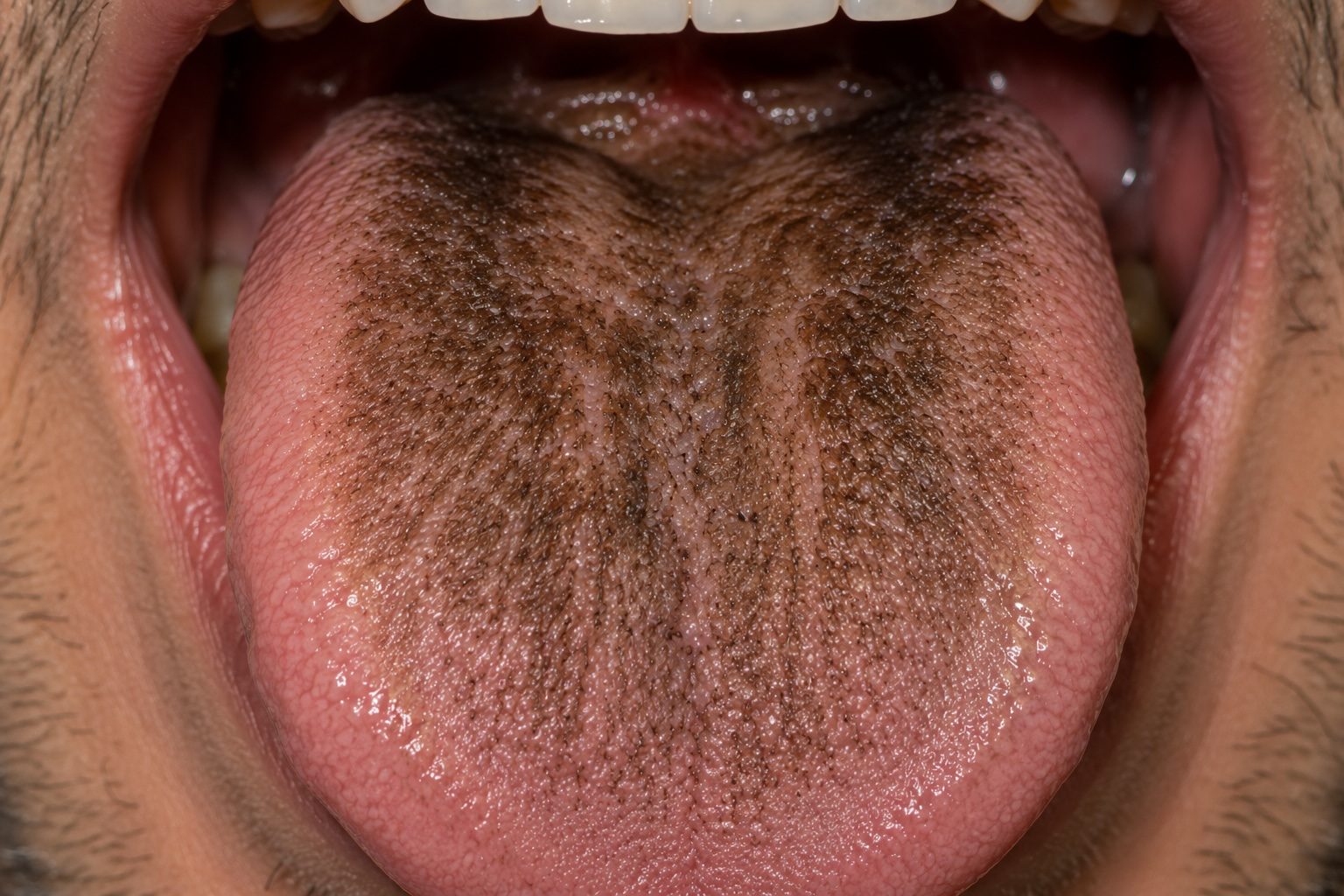 Black elongated papillae on the dorsum of the tongue