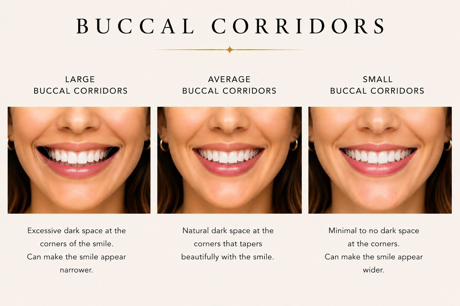 Buccal corridors — full smile front view