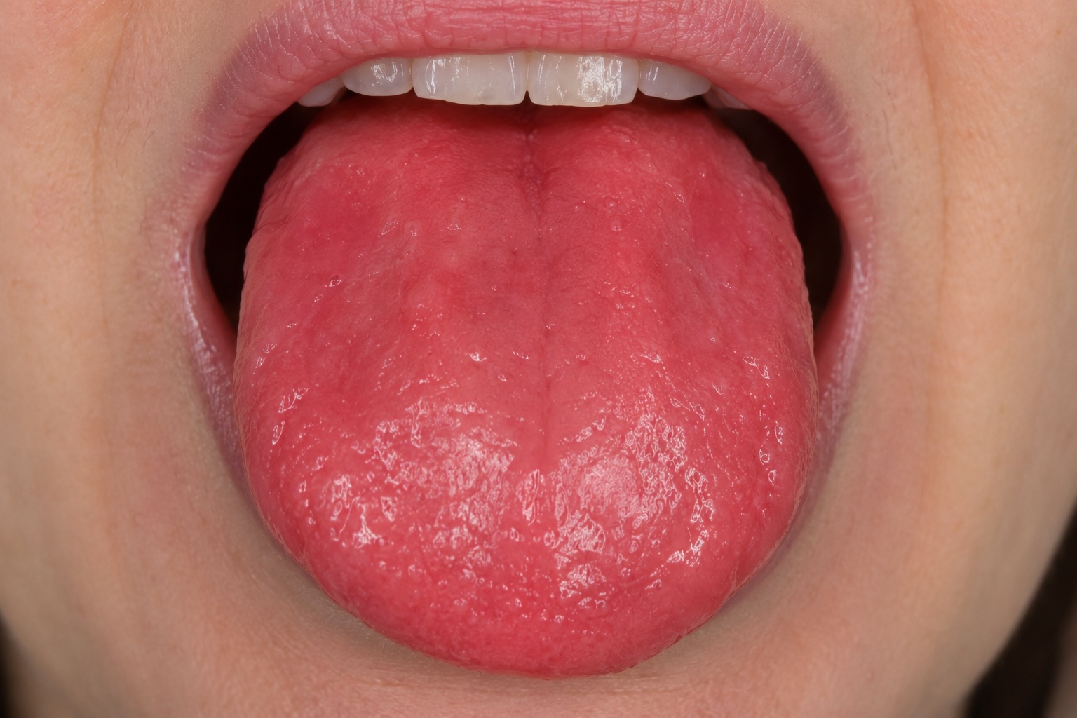 Atrophic glossitis — smooth, erythematous tongue surface
