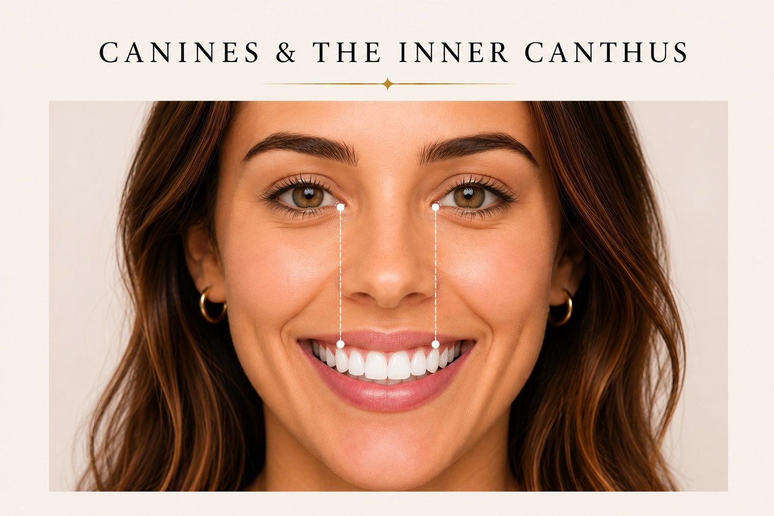 Inner canthus lines dropped to canine tips