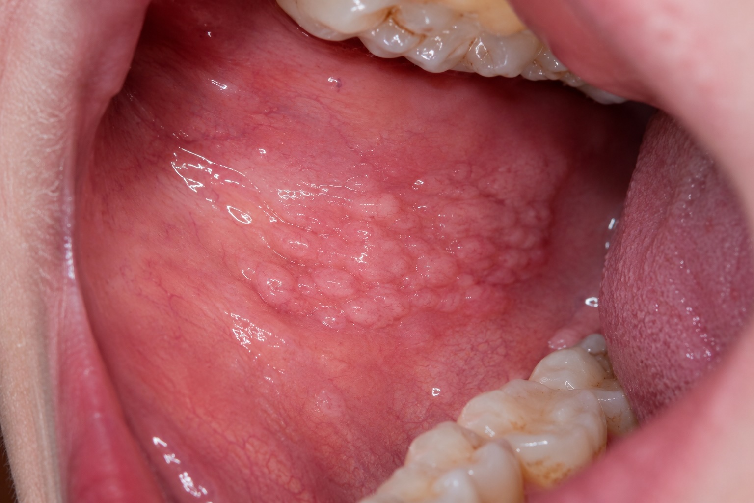 Cobblestone appearance of the buccal mucosa — Crohn's disease
