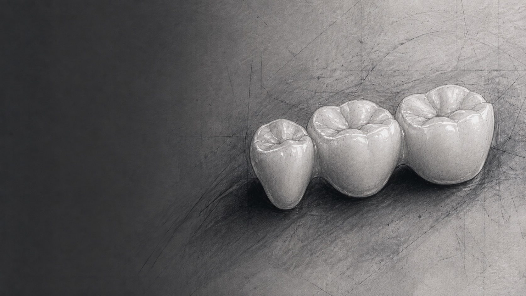 Dental Bridge Element Dental