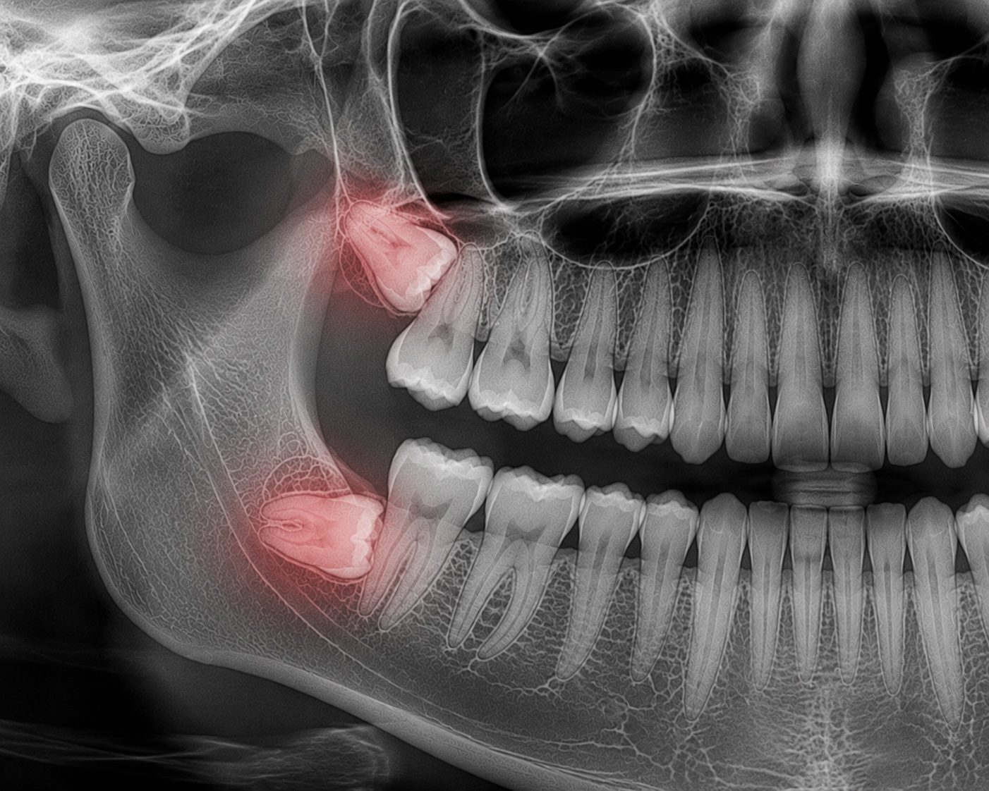 Illustration of impacted wisdom teeth at Element Dental