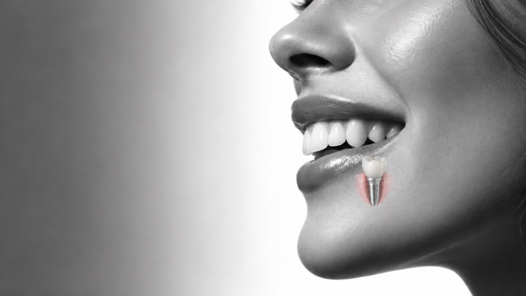 Dental Implants: Common Concerns