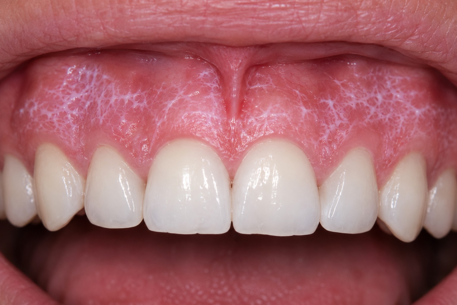 Reticular lichen planus on the buccal mucosa