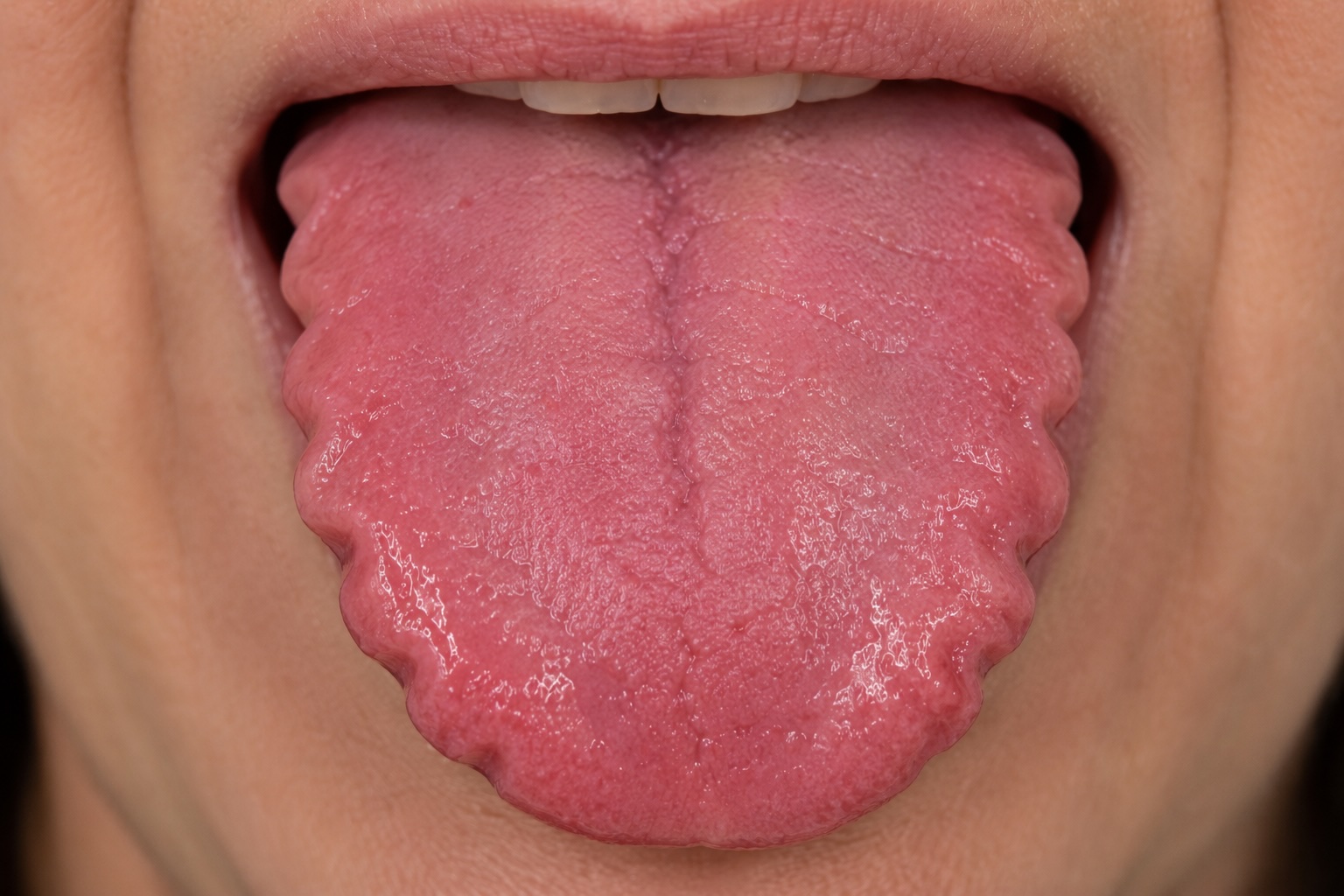 Scalloped tongue margins from prolonged pressure against the teeth