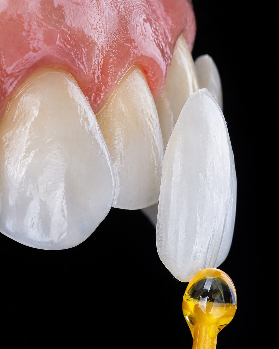 Porcelain Veneers